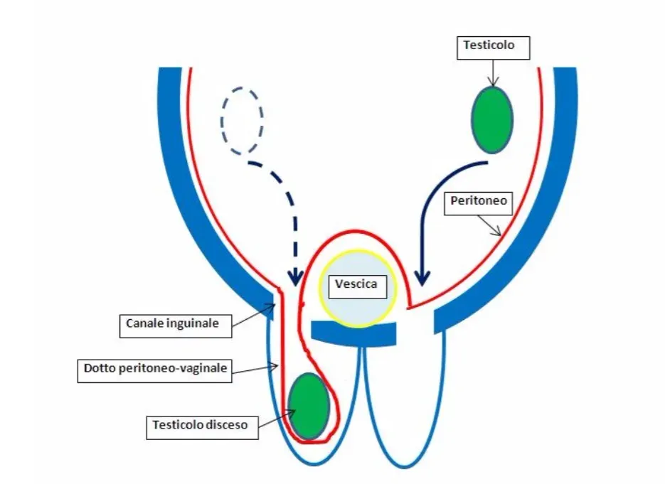 L’ernia inguinale nel bambino ernia inguinale benvenuti