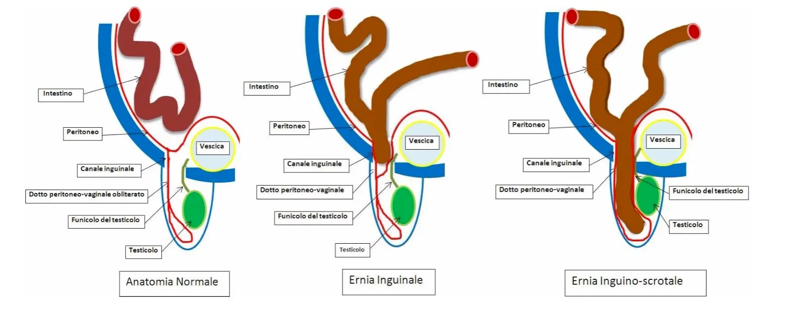 L’ernia inguinale nel bambino tipologia ernia inguinale