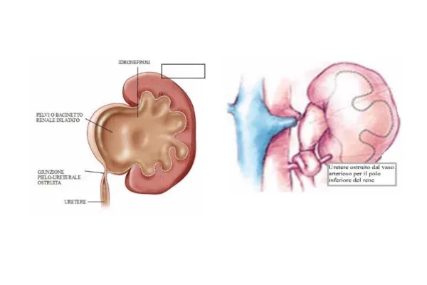 Idronefrosi nel bambino - la stenosi del giunto idronefrosi-nel-bambino-benvenuti