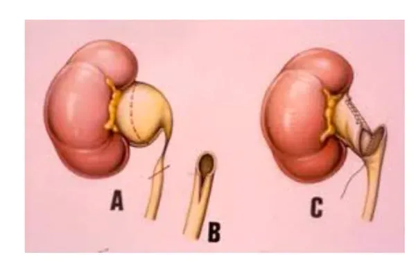Idronefrosi nel bambino - la stenosi del giunto idronefrosi-nel-bambino-benvenuti