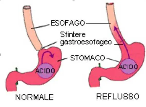 mal-di-schiena-libellula-reflusso