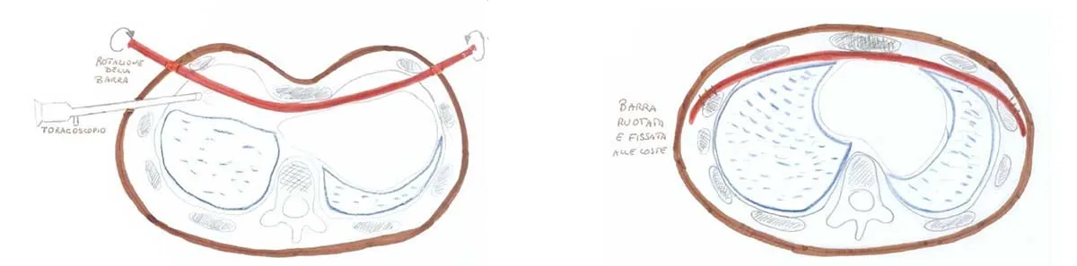 Petto escavato (Pectus Excavatum) petto-escavato-benvenuti-terapia