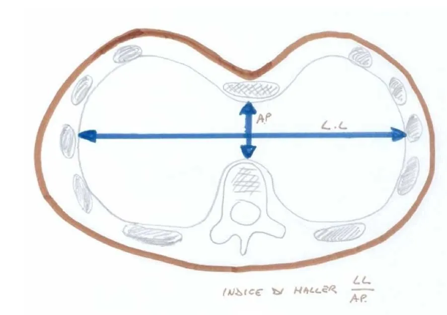 Petto escavato (Pectus Excavatum) petto-escavato-benveuti-indice-heller