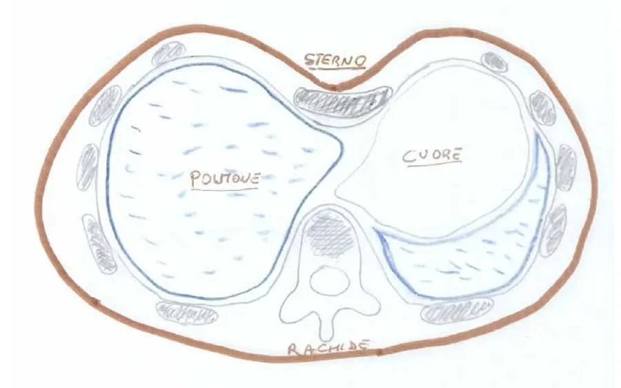 Petto escavato (Pectus Excavatum) petto-escvato-benvenuti-diagnosi