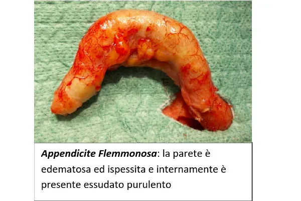 L’appendicite appendicite-articolo-benvenuti-per-bresciabimbi