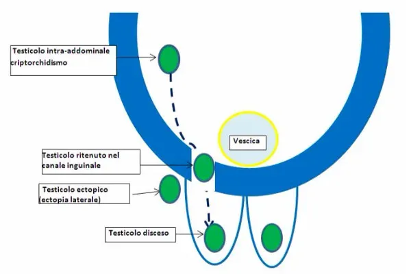 Criptorchidismo, ritenzione, ectopia testicolare e testicolo mobile chiptorchidismo-articolo-benvenuti-per-bresciabimbi