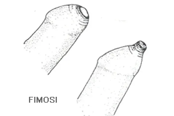 La fimosi nel bambino fimosi-nel-bambino-articolo-benvenuti-per-bresciabimbi