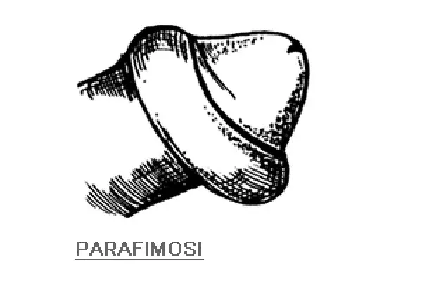 La fimosi nel bambino fimosi-nel-bambino-parafimosi-articolo-benvenuti-per-bresciabimbi