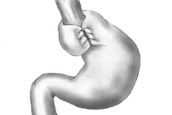 reflusso-gastroesofageo-RGE-intervento-articolo-benvenuti-per-bresciabimbi